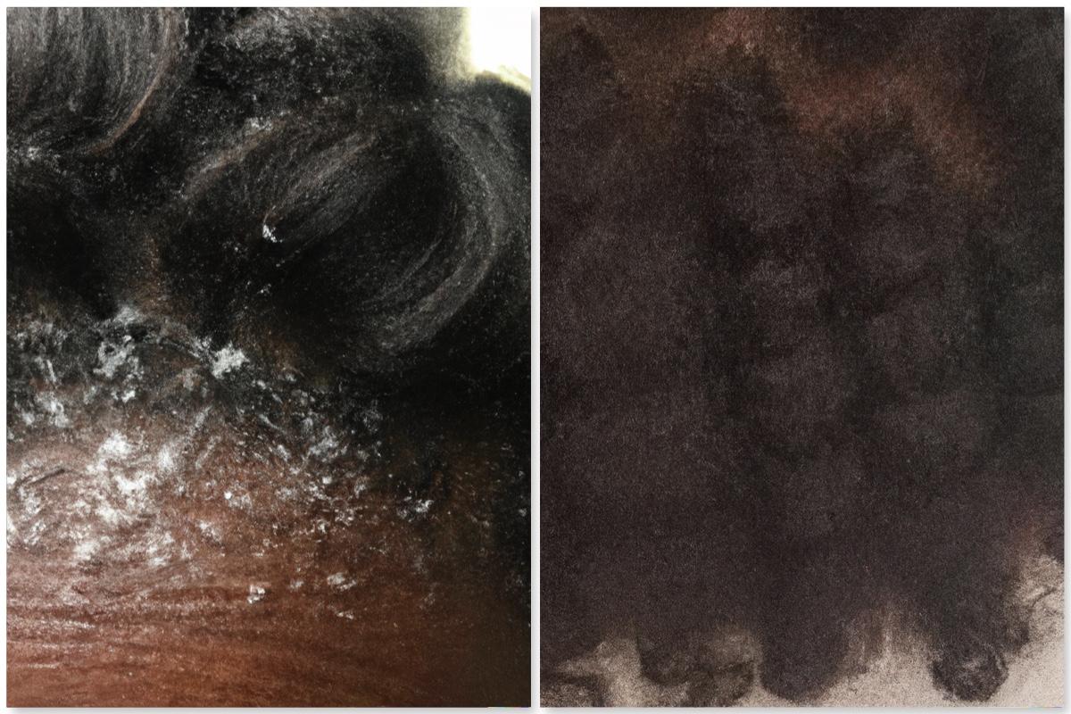 Dandruff scalp