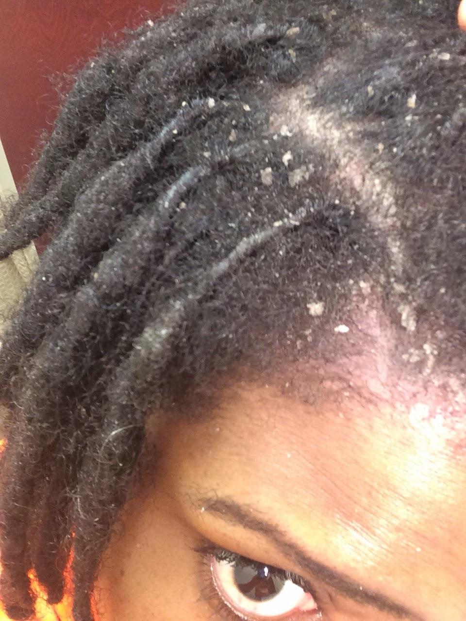 Flaky scalp